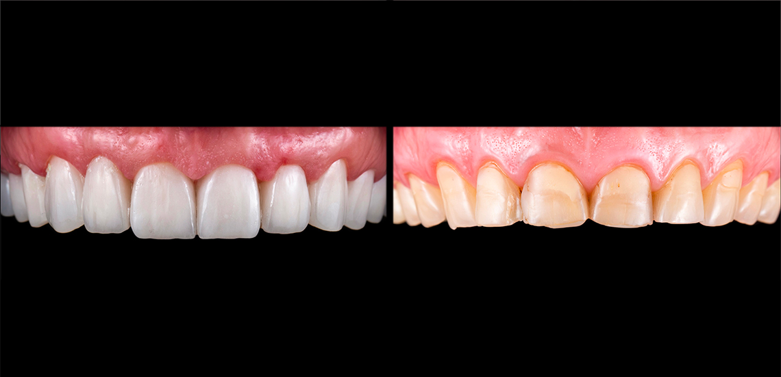 Faccette dentali