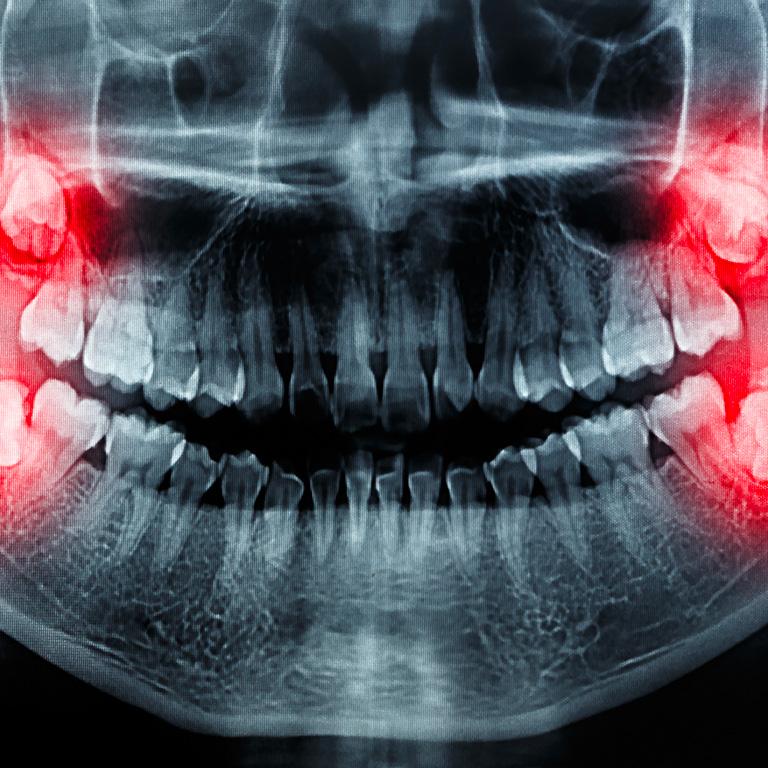 Estrazione dei denti del giudizio