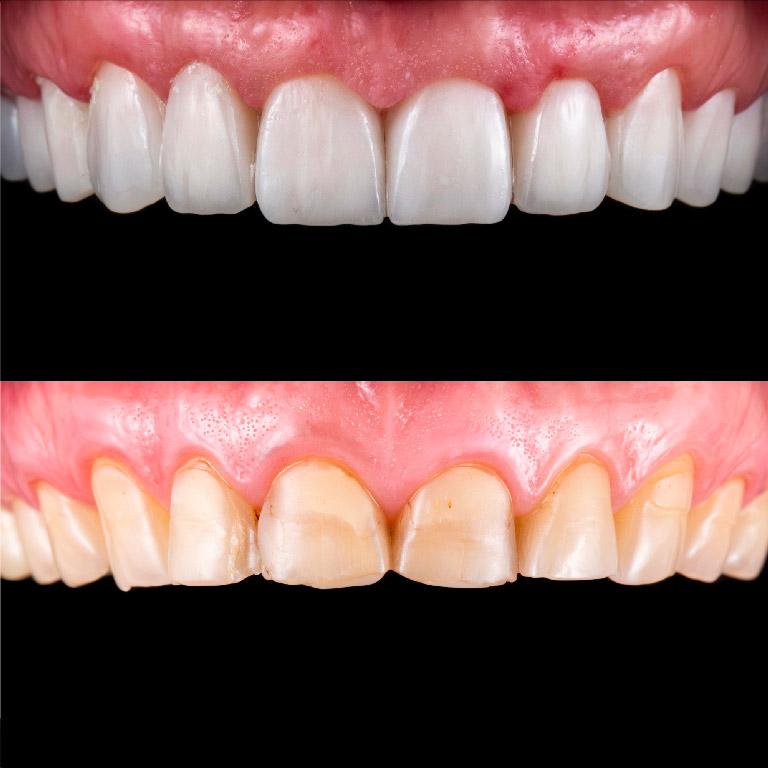 Faccette dentali