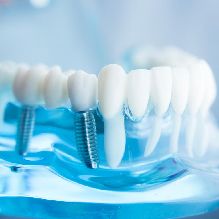Implantologia dentale